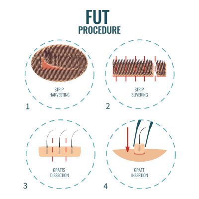 What Are The Different Types Of Hair Transplants Digital Market