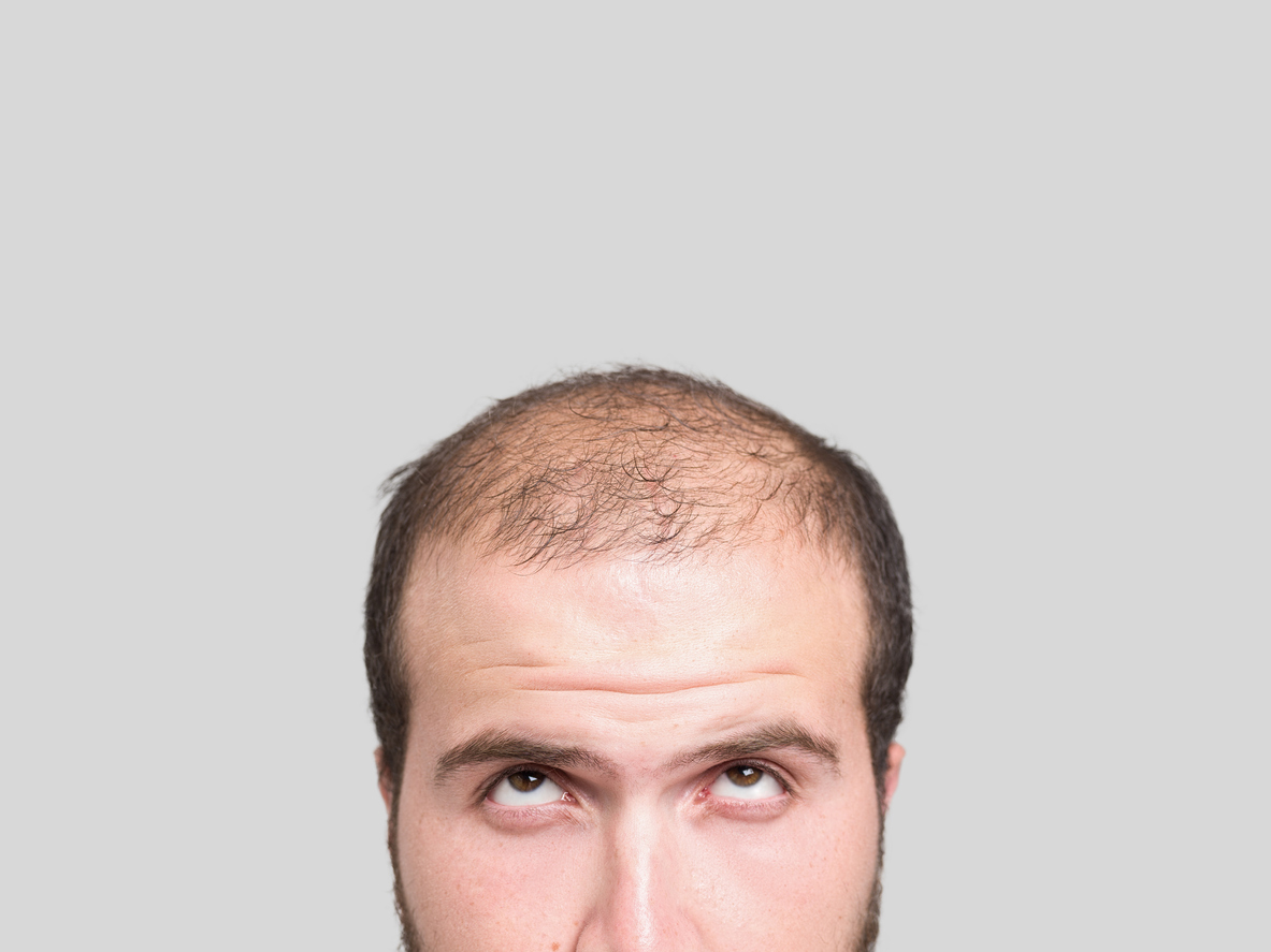 male pattern alopecia
