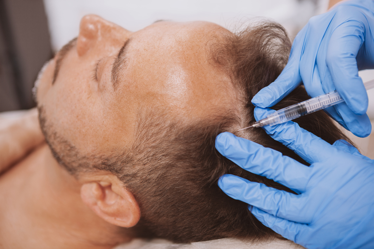 hair loss treatment in male